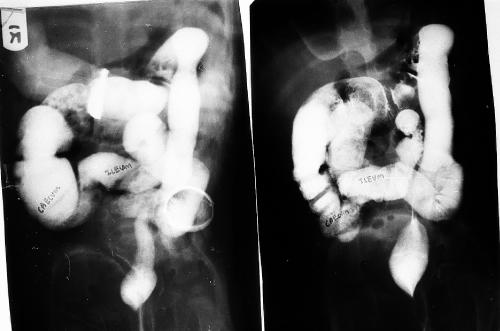 A Rare Constellation of Multiple Allergies, Chronic Urticaria, Micronutrient Deficiencies, and Multisystem Manifestations of Colorectal Motility Disorder in a Teenage Girl