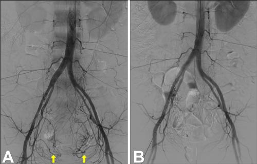 Diagnosing Excessive Irrigation Fluid Intravasation During Operative Hysteroscopy: A Case Report