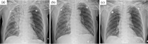 Unilateral Total Atelectasis Caused by Endobronchial Secretion: A Case Report