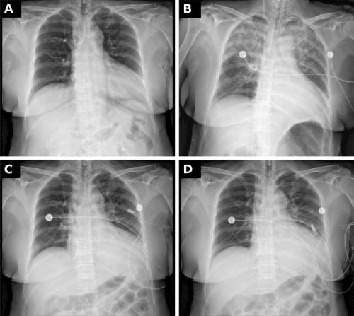 Postextubation Upper-Airway Obstruction Leading to Negative-Pressure Pulmonary Edema and Hypoxic Cardiac Arrest Despite Apparent Recovery After Sugammadex Reversal: A Case Report