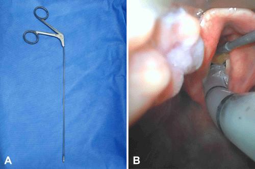 Airway Management Using Spoon Forceps for Stabilization of a Large Vocal Cord Mass During Endotracheal Intubation: A Case Report