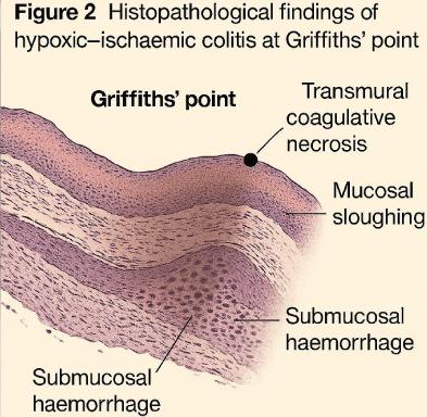 Hypoxic-Ischemic Colitis at Griffiths’ Point in a Term Infant with Hypoxic-Ischemic Encephalopathy and Acute Kidney Injury Requiring Emergency Subtotal Colectomy