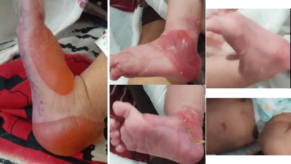 Neonatal Epidermolysis Bullosa Simplex: Early Diagnostic Clarification and Multidisciplinary Management in a Term Female Infant