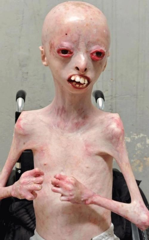 The First Documented Iraqi Case of Progeria: Clinical Discovery, Rare-Disease Medicine, and a Vision for Transforming Iraqi Medicine from Knowledge Consumer to Knowledge Produce