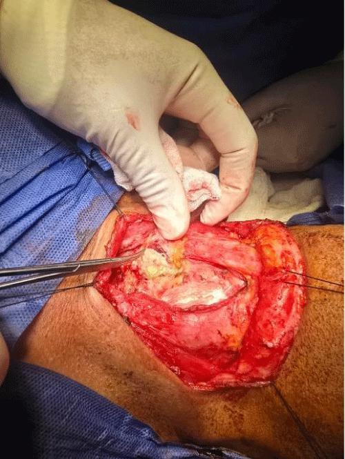 Novel Tracheal Reconstruction Using NEOVEIL® PGA Felt and Sternothyroid Flap