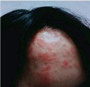 Psoriasis: True Etiology and Complete Cure