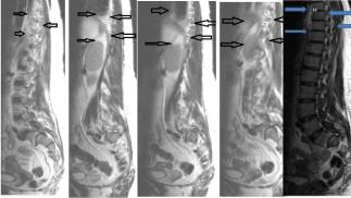 Metastatic Salmonella Thoracic Discitis in a 52‑Year‑Old Woman Following Febrile Diarrheal Illness and Mediastinal Lymphadenitis: A Complex Diagnostic Journey Across Two Continents