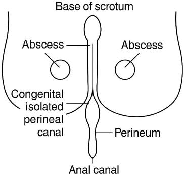 Recurrent Perineal Abscesses Arising from a Congenital Isolated Perineal Canal Mimicking Crohn’s Disease: A 22‑Year Diagnostic Odyssey