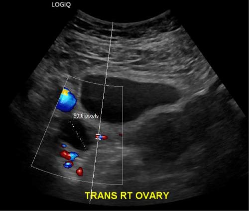 An Atypical Presentation of Pelvic Inflammatory Disease in a Patient with Autism: A Case Report