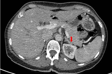 Abdominal Aortic Dissection Associated with Primary Aldosteronism: A Case Report and Review of Emerging Evidence