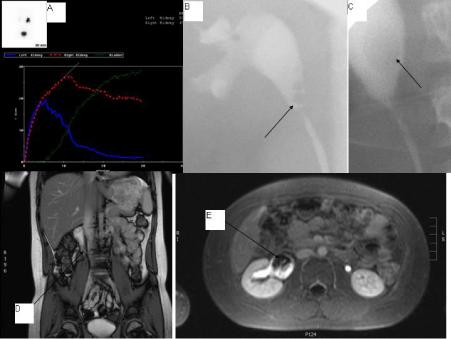Ureteric Fibroepithelial Polyp in a Child-Recurrent Presentations and Diagnostic Dilemma