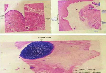 A Very Rare Case of Ovarian Collision Tumor with Contralateral Endometriotic Cyst: Fertility-Sparing Surgical Management