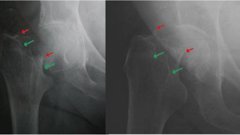 A Radiographic Classification System for Intracapsular Hip Fractures that Reflects Fracture Displacement and Predicts Complications after Internal Fixation: A Clinical Study of 2262 Patients