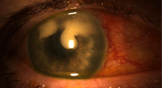 Reconstruction of a Leaking Filtering Bleb after Trabeculectomy Using Amniotic Membrane Transplantation and Contralateral Conjunctival Autograft: A Case Report