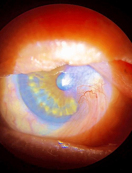 Recurrent Nasal Pterigium