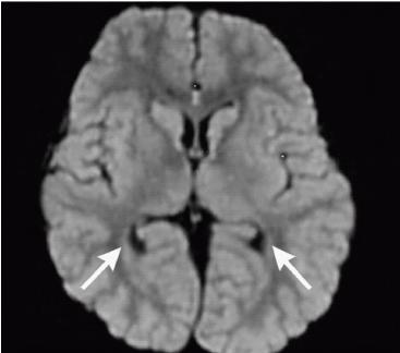 The 20th Case Cured from Autism: A Child with Neurodevelopmental White-Matter Dysmaturation