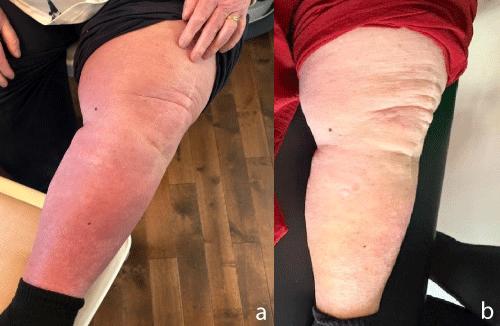 Improving Function in Chronic Lower Extremity Lymphedema Through Clinical Pilates: A Case Study