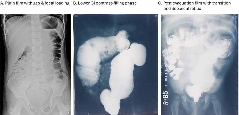 Recurrent Respiratory Tract Infections and Pneumonia in a 4‑Year‑Old Girl with Unrecognized Hypoganglionosis Successfully Treated with Transanal Endosurgical Modified Anorectal Myomectomy
