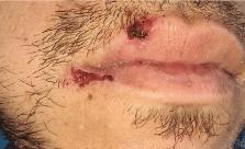 Pleuropulmonary Staphylococcal Disease in Young Immunocompetent Man: A Case Report