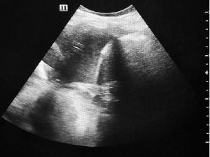 Lupus Pleurisy Revealing Systemic Lupus Erythematosus with Severe Renal Involvement: A Case Report