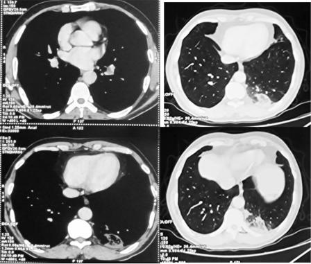 From Pulmonary Embolism to Arterial Pseudoaneurysm: A Case of Aggressive Primary Antiphospholipid Syndrome with DOAC Failure