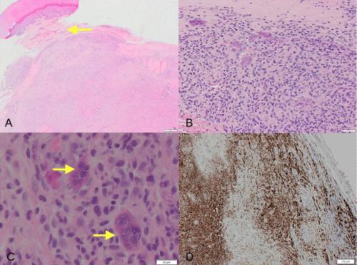 Giant Cell Tumour of the Tendon Sheath in the Distal Phalanx of the Third Toe