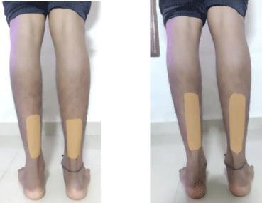 Comparison of Immediate Effects of Kinesio-taping Versus Sham Taping on Functional Mobility Among Diabetic Neuropathy Patients – A Single Blinded Randomized Control Study