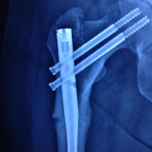 Non-Invasive Treatment of Delayed Union in Human Long Bones