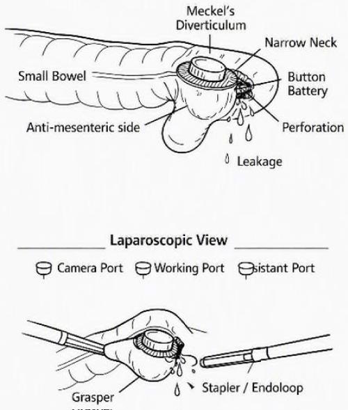 Pediatric Surgical Toxicology: High Risk Ingestions, Congenital Anomalies, and Operative Management Pathways