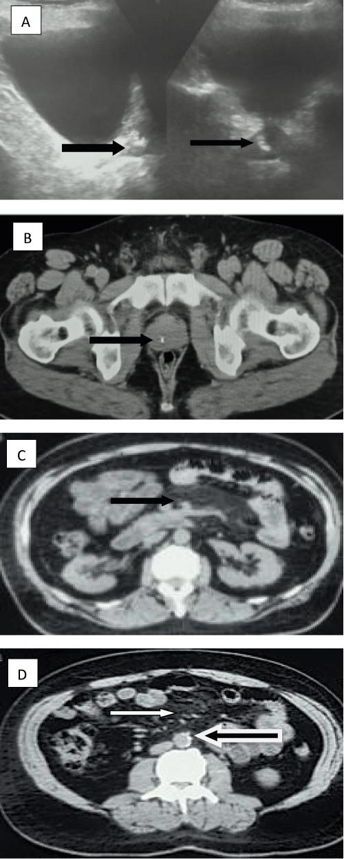 A Case of Prostatic Calcification with Mesenteric Panniculitis: Presented with Prostatic Cancer